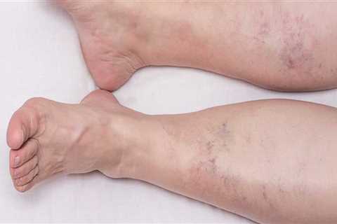 Understanding the Risks of Vein Disease Treatments in St. Louis, Missouri