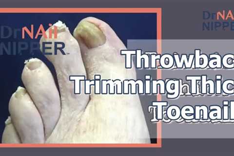 Throwback - Trimming Thick Toenails with Dr Nail Nipper