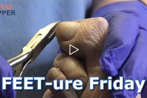 FEETure Friday | Severe Rheumatoid Arthritis on the Feet #drnailnipper