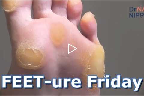 FEETure Friday | Why are these calluses SOOOOO Thick #callustoday #callusnow