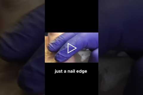 Curious about nail removal recovery? #NailCare #RecoveryJourney #HealthTips