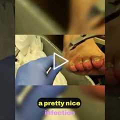 Unique Nail Treatment Insights 🦶💡