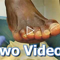 Dr Nail Nipper with Two Videos #drnailnipper #podiatrycare #footcaretips
