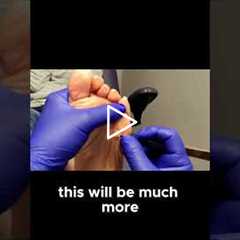 Why You Should Never Ignore a Keratotic Horn on Your Foot!
