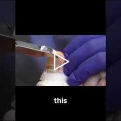 Watch a Toenail Removal and Cleaning Like You've Never Seen! #ToenailRemoval #FootCareTips