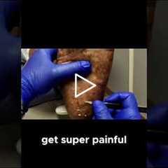 Keeping Calluses in Check The Importance of Regular Foot Care Visits