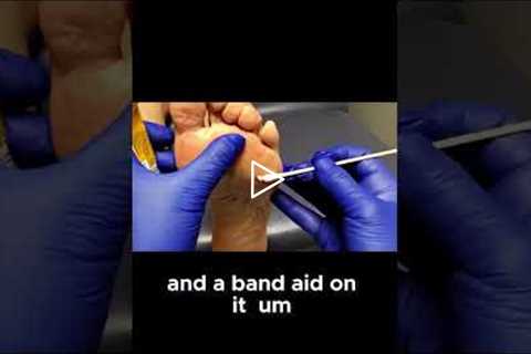 The Painful Reality of Neglected Callus and How to Fix Them #callusremoval