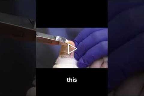 Watch a Toenail Removal and Cleaning Like You've Never Seen! #ToenailRemoval #FootCareTips