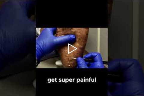 Keeping Calluses in Check The Importance of Regular Foot Care Visits
