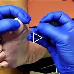 Deep Callus Removal & A Lesson in Positivity #DrNailNipper #CallusRemoval #FootCare #Podiatry