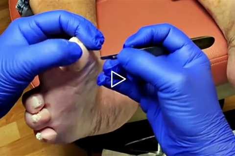 Deep Callus Removal & A Lesson in Positivity #DrNailNipper #CallusRemoval #FootCare #Podiatry