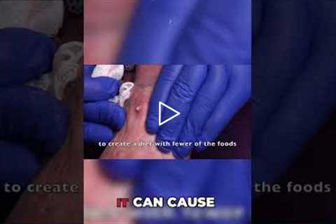 Medication Impact Hydrochlorothiazide and Gout