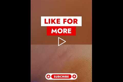 Understanding Blunt Excision Technique! 🩺 #WartRemoval #podiatry  #medicalprocedures  #dermatology