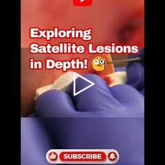 Exploring Satellite Lesions in Depth! 🧐