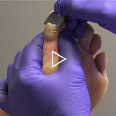 Why These Calluses Come Back Every 6 Weeks 🦶🧬 #CallusCare #FootCare #Podiatry