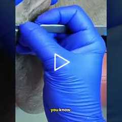 Did this callus suddenly become painful? 👣 | The Most Painful Part of a Podiatrist's Job