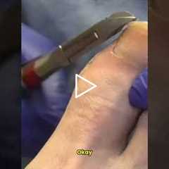 How Podiatrists Get Toenails Perfectly Smooth #nailcare #satisfying