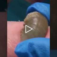 Super Bowl of Dr Nail Nipper - Original Rams Horn Toenail - Part 1