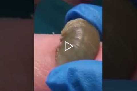 Super Bowl of Dr Nail Nipper - Original Rams Horn Toenail - Part 1