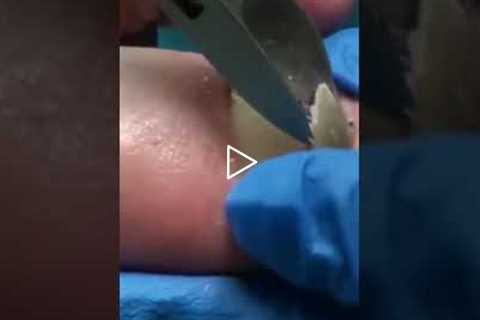 Dog Hair Under a Toenail?! The Real Story Behind This Nail – Halftime