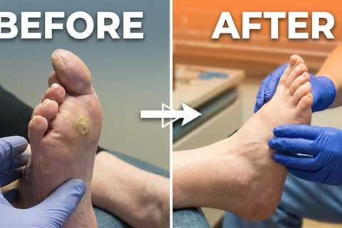 Severe Callus Relief — Watch the Transformation | The Bigger Callus was Less Painful