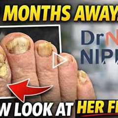FEET-ure Friday | She Stayed Away 10 Months… These Toenails Tell the Story