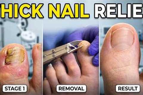 FEET-ure Friday |  Thick Toenail Caused a Hidden Wound (Diabetic Foot Warning)