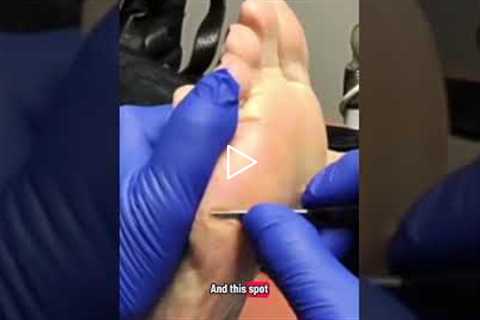 How to treat calluses and corns