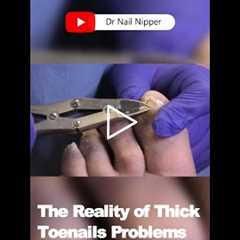 The Reality of thick Toenails Problems and Solutions 🦶