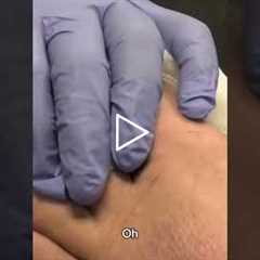 Blizzard Talk During Foot Treatment ❄️😂 | Podiatry Fun