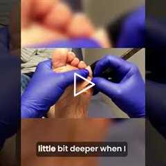 Follow-Up Care for Foot Comfort | I Had to STOP… This Callus Was Too Painful 😳