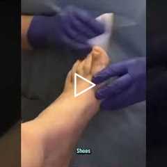 Fungus Re-infection The Crucial Step Your Doctor Might Miss