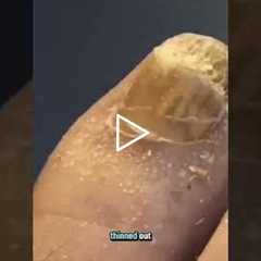 The Mystery of the Bleeding Toenail Why Does This Happen