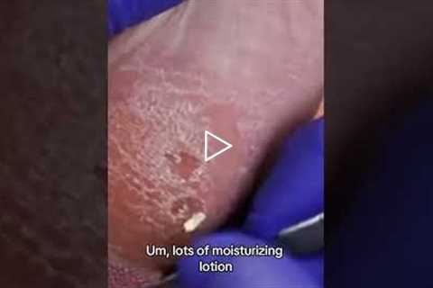 Walking with a stone in your shoe