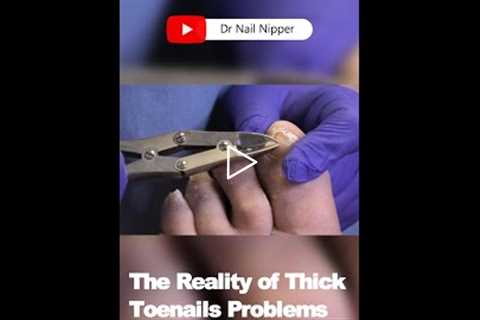 The Reality of thick Toenails Problems and Solutions 🦶