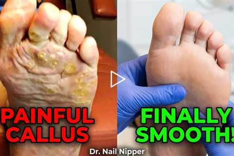Painful Genetic Callus Removed – Instant Relief!