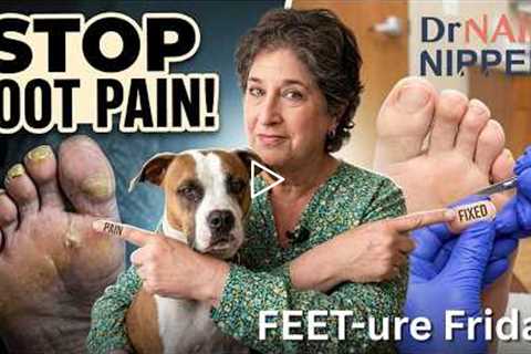 Friday FEET-ure | A Week of Calluses (Real Patients, Real Feet!)