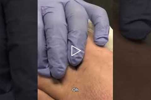 Blizzard Talk During Foot Treatment ❄️😂 | Podiatry Fun