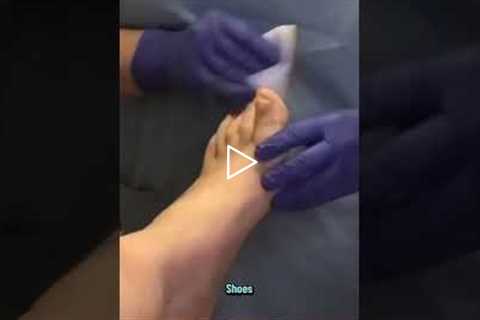 Fungus Re-infection The Crucial Step Your Doctor Might Miss