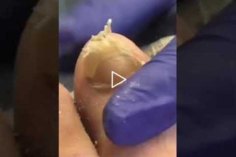 Pre-Diabetic to Healthier Her Amazing Weight Loss Journey | Lost 25 lbs… But Foot Pain Comes Back?