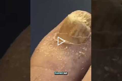The Mystery of the Bleeding Toenail Why Does This Happen