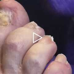 Why Does His Toe Hurt At Night? | Foot Care Visit
