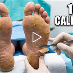 FEET-ure Friday | One Patient, 100 calluses