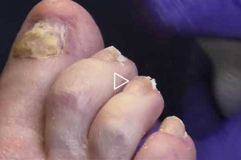Why Does His Toe Hurt At Night? | Foot Care Visit