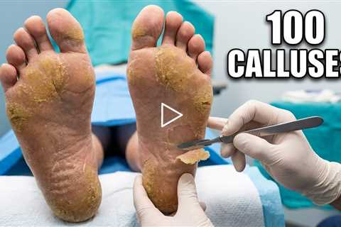 FEET-ure Friday | One Patient, 100 calluses