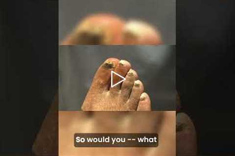 Is Your Nail Fungus Getting Worse? 😱 #healthcare #pedicure