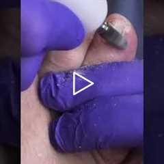Applying athlete's foot cream can make a big difference in comfort. See the results