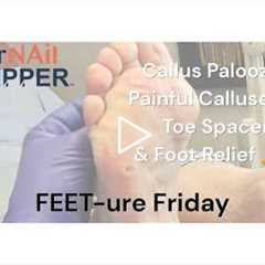 FEET-ure Friday | Callus Palooza | Painful Calluses, Toe Spacers & Foot Relief 🦶
