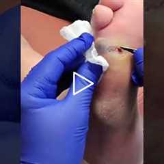 The First Step to Treating a Deep Foot Wound