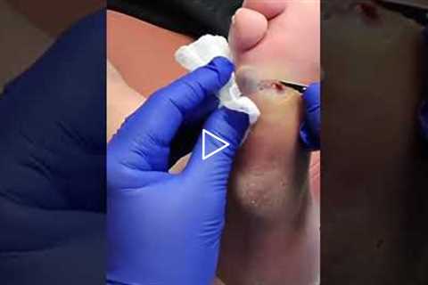 The First Step to Treating a Deep Foot Wound